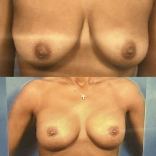 Breast Augmentation in NJ