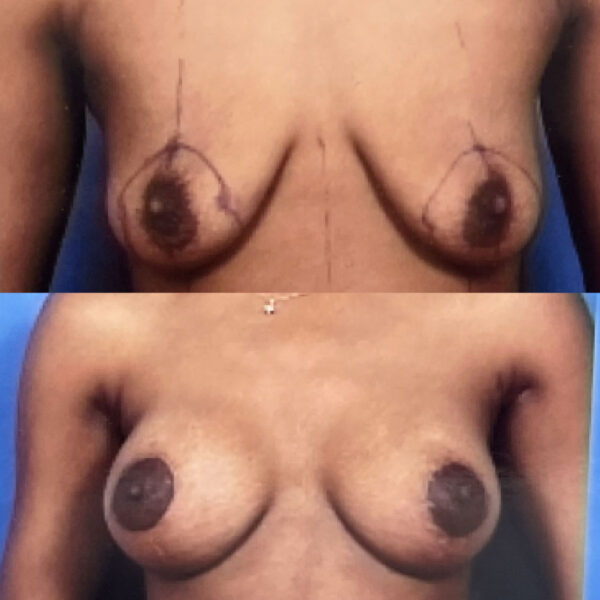 Mommy Makeover in NJ: Breast Augmentation