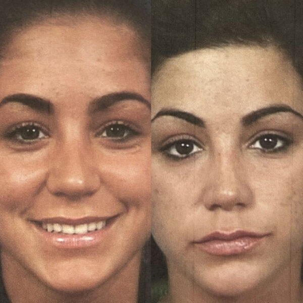 Rhinoplasty in NJ: Before & After
