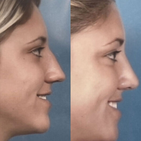 Top Rhinoplasty Surgeon in NJ: Before and After