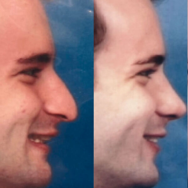 Male Rhinoplasty: Before & After