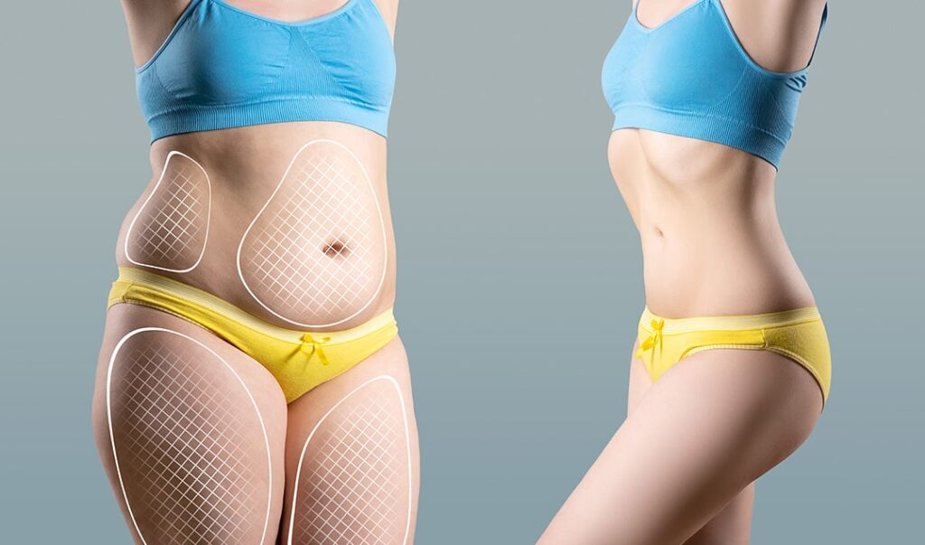 SmartLipo NJ